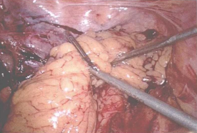 直肠吻合器钉子什么样腹腔镜结直肠手术 ｜ 吻合技术_https://www.jmylbn.com_新闻资讯_第9张