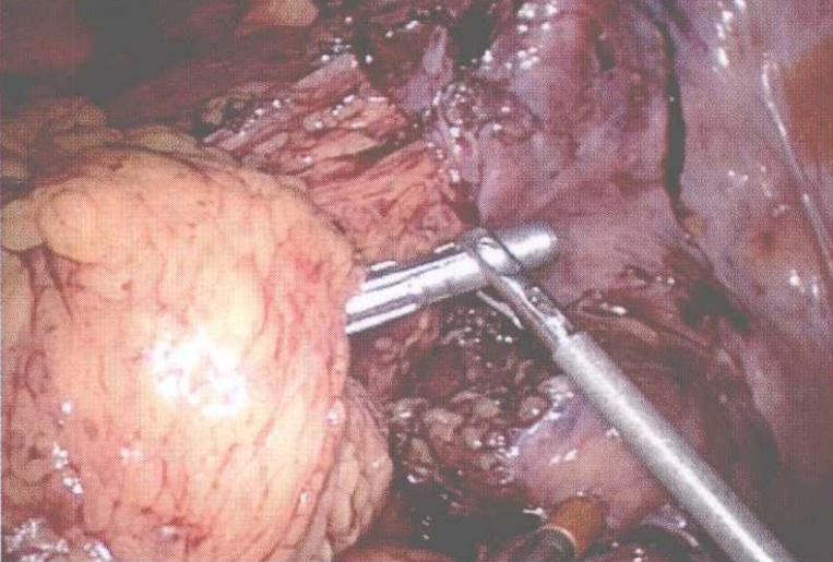 直肠吻合器钉子什么样腹腔镜结直肠手术 ｜ 吻合技术_https://www.jmylbn.com_新闻资讯_第6张