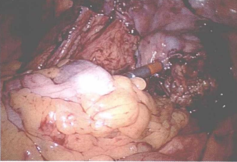 直肠吻合器钉子什么样腹腔镜结直肠手术 ｜ 吻合技术_https://www.jmylbn.com_新闻资讯_第7张