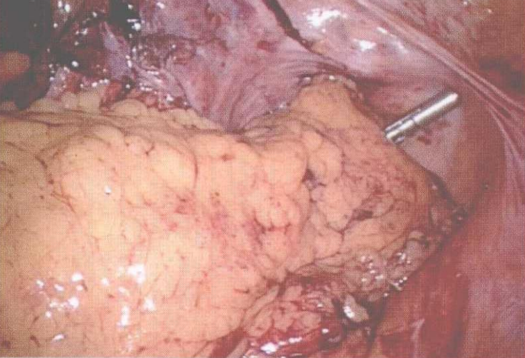 直肠吻合器钉子什么样腹腔镜结直肠手术 ｜ 吻合技术_https://www.jmylbn.com_新闻资讯_第2张