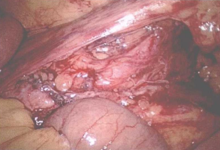 直肠吻合器钉子什么样腹腔镜结直肠手术 ｜ 吻合技术_https://www.jmylbn.com_新闻资讯_第5张