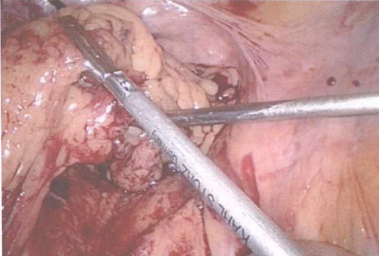 直肠吻合器钉子什么样腹腔镜结直肠手术 ｜ 吻合技术_https://www.jmylbn.com_新闻资讯_第11张