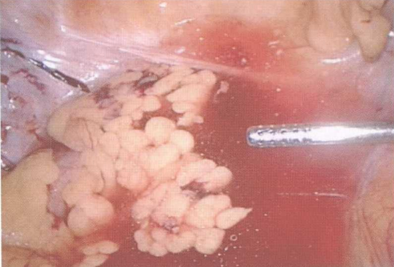 直肠吻合器钉子什么样腹腔镜结直肠手术 ｜ 吻合技术_https://www.jmylbn.com_新闻资讯_第10张