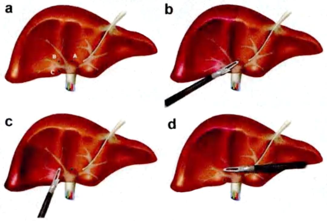 腹腔镜篇复杂肝切除术