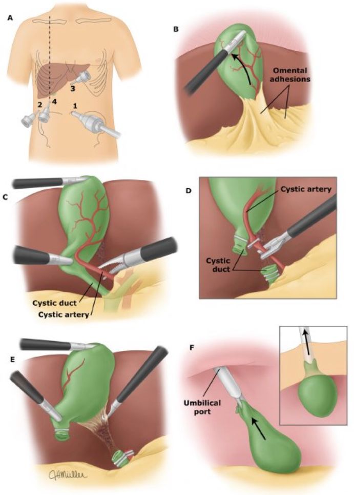 手术中怎么选择针腔镜手术中你知道怎么选择穿刺通道吗？_https://www.jmylbn.com_新闻资讯_第3张