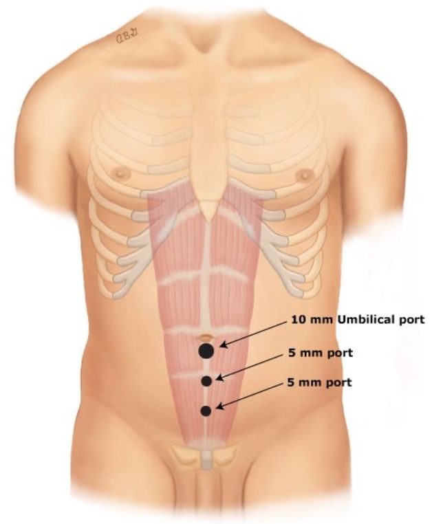 手术中怎么选择针腔镜手术中你知道怎么选择穿刺通道吗？_https://www.jmylbn.com_新闻资讯_第5张