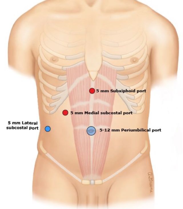 手术中怎么选择针腔镜手术中你知道怎么选择穿刺通道吗？_https://www.jmylbn.com_新闻资讯_第2张