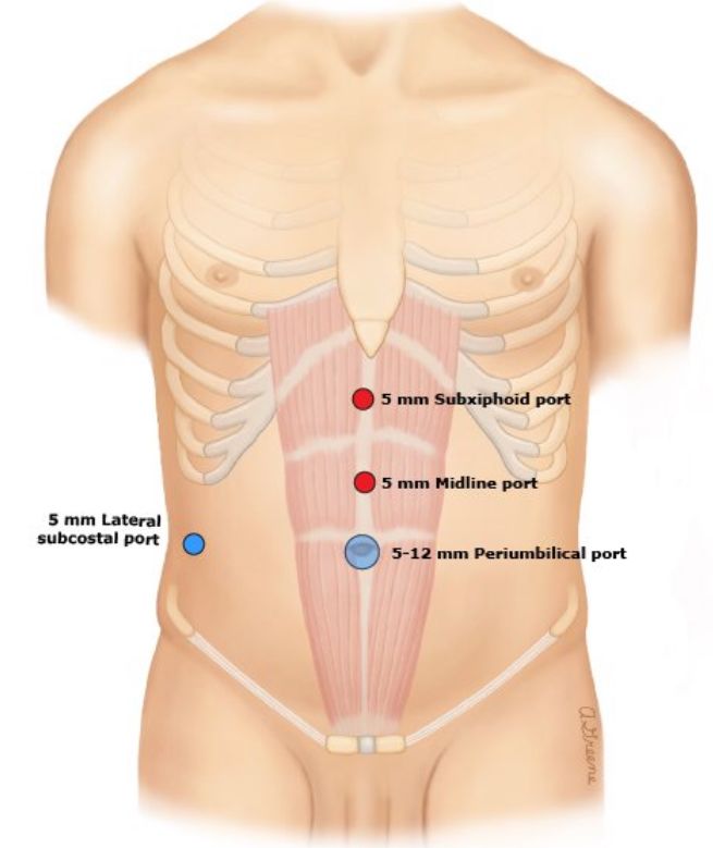 手术中怎么选择针腔镜手术中你知道怎么选择穿刺通道吗？_https://www.jmylbn.com_新闻资讯_第4张