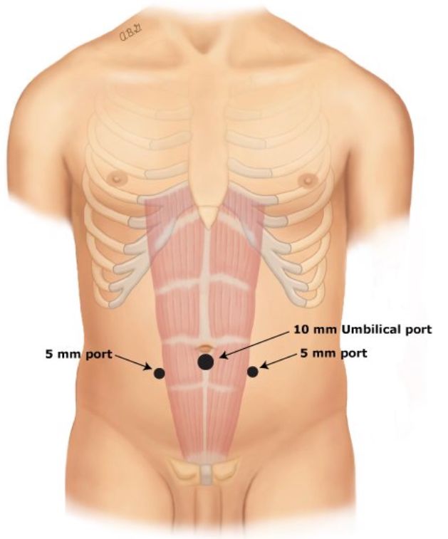 手术中怎么选择针腔镜手术中你知道怎么选择穿刺通道吗？_https://www.jmylbn.com_新闻资讯_第6张