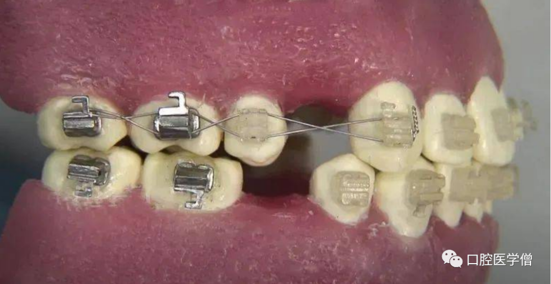 正畸操作小技巧：尖牙向后结扎