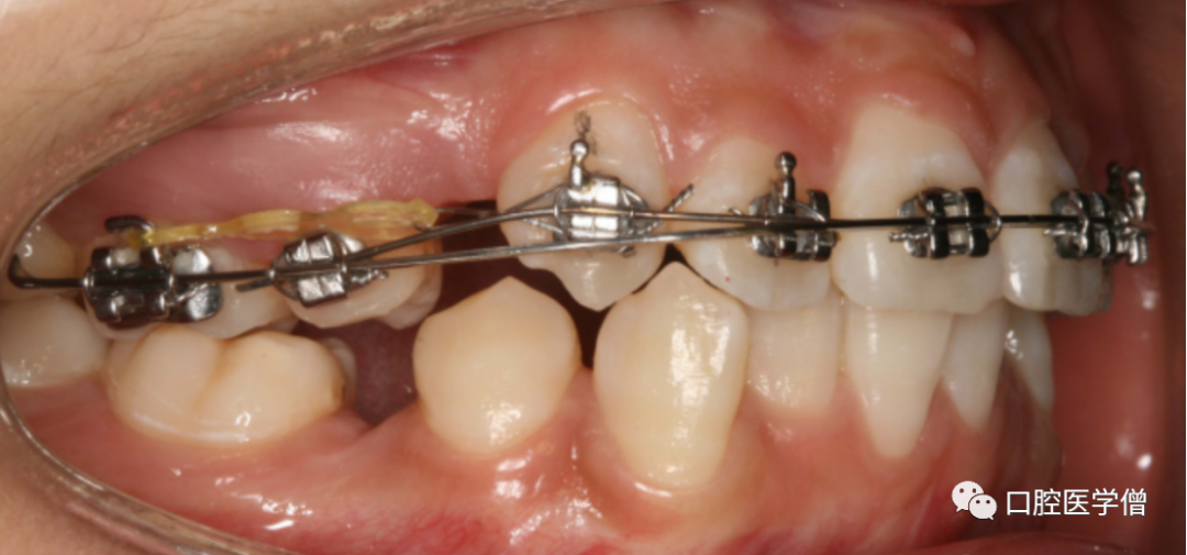 正畸操作小技巧：尖牙向后结扎