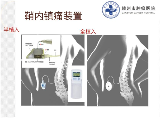 为什么要用泵打针医疗技术 ｜ “镇痛泵体内植入术”还“癌痛患者一个无痛人生”！_https://www.jmylbn.com_新闻资讯_第6张