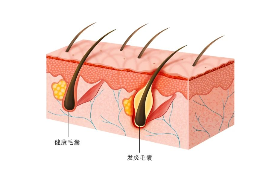 唤醒休眠的毛囊，可以重新长出头发