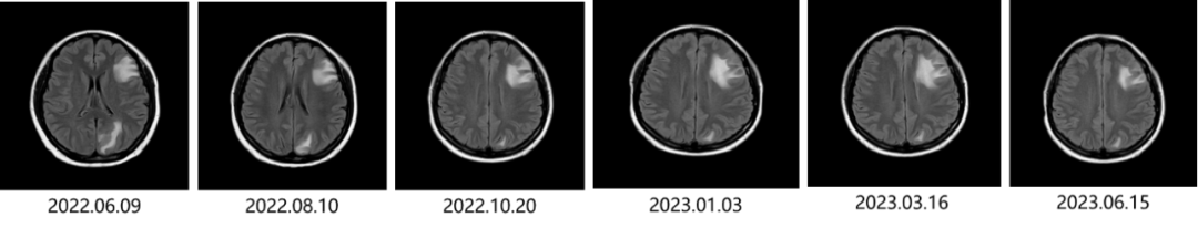 乳腺cr是什么予她时光 向未来 ｜ 消失的“它”？肝转移灶CR！_https://www.jmylbn.com_新闻资讯_第2张