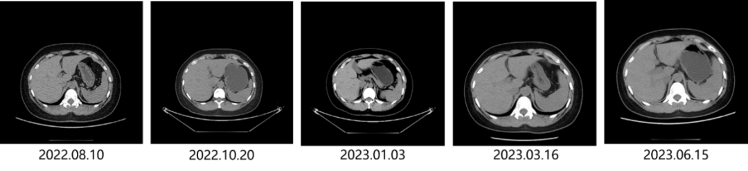 乳腺cr是什么予她时光 向未来 ｜ 消失的“它”？肝转移灶CR！_https://www.jmylbn.com_新闻资讯_第1张