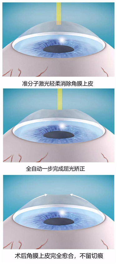 @2022准备报考军校/警校等院校的近视学生，攻略来了(图4)