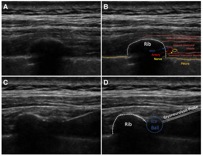 医疗探针怎么做术前超声引导下经皮冷冻消融术治疗乳腺切除术后疼痛：一项随机、双盲、空白对照研究_https://www.jmylbn.com_新闻资讯_第3张