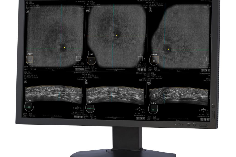 什么是超声容积探头【科普】自动乳腺容积超声成像（ABUS）_https://www.jmylbn.com_新闻资讯_第3张