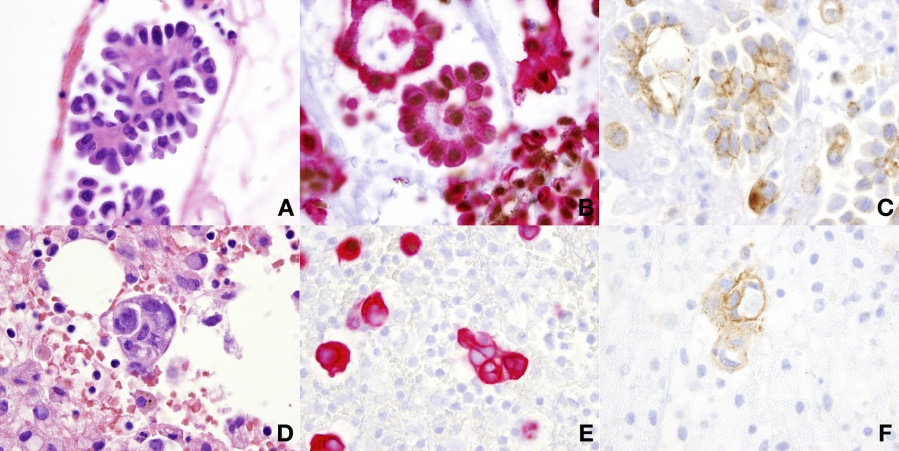 什么是病理蜡块晚期肿瘤诊断利器 —— 病理科细胞蜡块技术_https://www.jmylbn.com_新闻资讯_第4张