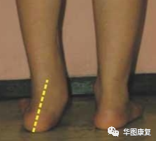 步态分析上曲线怎么解读步态分析，认识我们的步态和异常步态_https://www.jmylbn.com_新闻资讯_第11张