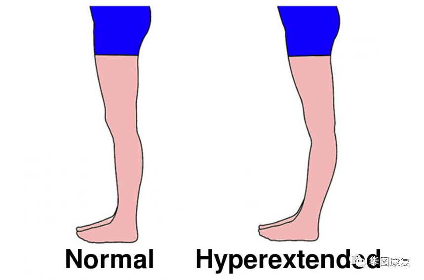 步态分析上曲线怎么解读步态分析，认识我们的步态和异常步态_https://www.jmylbn.com_新闻资讯_第12张