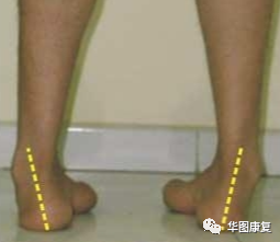 步态分析上曲线怎么解读步态分析，认识我们的步态和异常步态_https://www.jmylbn.com_新闻资讯_第10张