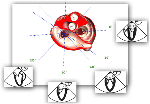 什么叫超声容积探头围手术期经食管超声心动图监测操作的专家共识（可下载）_https://www.jmylbn.com_新闻资讯_第78张
