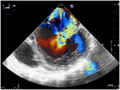 什么叫超声容积探头围手术期经食管超声心动图监测操作的专家共识（可下载）_https://www.jmylbn.com_新闻资讯_第80张