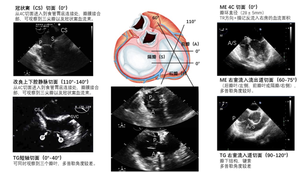 什么叫超声容积探头围手术期经食管超声心动图监测操作的专家共识（可下载）_https://www.jmylbn.com_新闻资讯_第84张