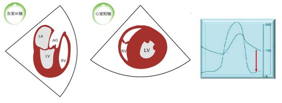 什么叫超声容积探头围手术期经食管超声心动图监测操作的专家共识（可下载）_https://www.jmylbn.com_新闻资讯_第67张