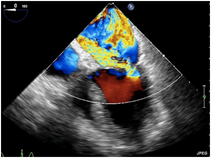 什么叫超声容积探头围手术期经食管超声心动图监测操作的专家共识（可下载）_https://www.jmylbn.com_新闻资讯_第81张