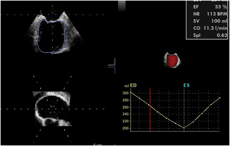 什么叫超声容积探头围手术期经食管超声心动图监测操作的专家共识（可下载）_https://www.jmylbn.com_新闻资讯_第50张