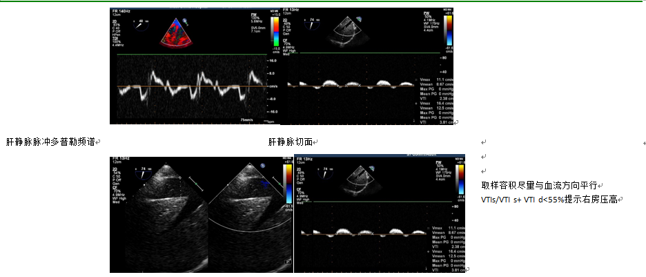 什么叫超声容积探头围手术期经食管超声心动图监测操作的专家共识（可下载）_https://www.jmylbn.com_新闻资讯_第57张