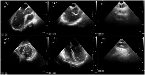 什么叫超声容积探头围手术期经食管超声心动图监测操作的专家共识（可下载）_https://www.jmylbn.com_新闻资讯_第38张
