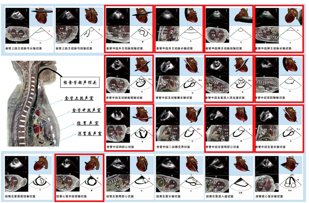 什么叫超声容积探头围手术期经食管超声心动图监测操作的专家共识（可下载）_https://www.jmylbn.com_新闻资讯_第37张