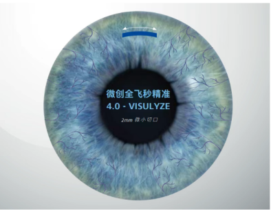 烟台华厦康爱眼科：对比全飞秒4.0 vs. 全飞秒3.0，到底升级了什么？