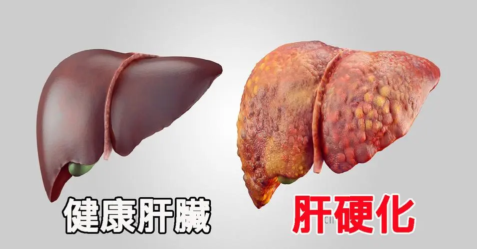 肝硬化吐血能活多久