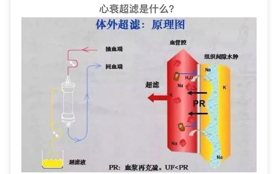 血滤机什么品牌好【微技术】带您认识血液净化中心的救命利器——床旁血滤机_https://www.jmylbn.com_新闻资讯_第3张