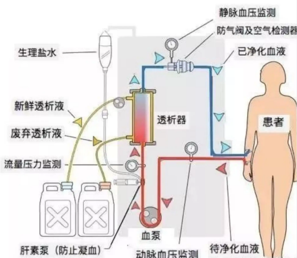 血滤机什么品牌好【微技术】带您认识血液净化中心的救命利器——床旁血滤机_https://www.jmylbn.com_新闻资讯_第2张