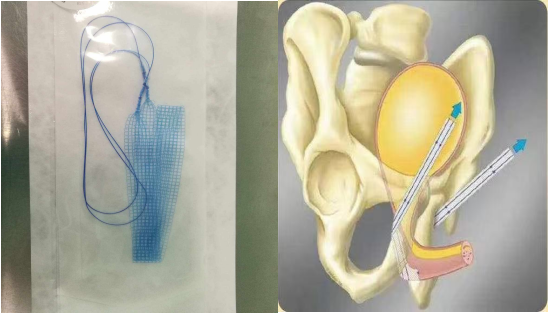 医讯怎么用【医讯】女性尿失禁不用愁，一根吊带解烦忧_https://www.jmylbn.com_新闻资讯_第5张