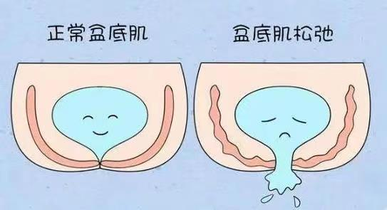 医讯怎么用【医讯】女性尿失禁不用愁，一根吊带解烦忧_https://www.jmylbn.com_新闻资讯_第3张