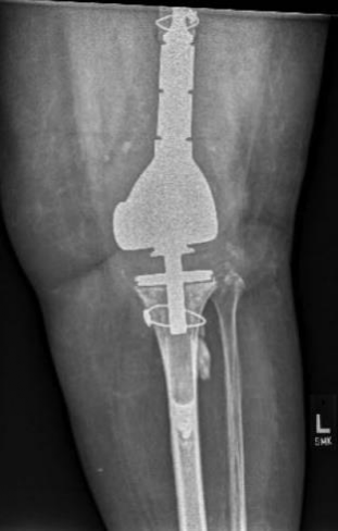 肋骨固定板怎么拆手术技巧：全膝关节翻修如何取出固定良好的胫骨柄锥_https://www.jmylbn.com_新闻资讯_第3张