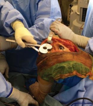 肋骨固定板怎么拆手术技巧：全膝关节翻修如何取出固定良好的胫骨柄锥_https://www.jmylbn.com_新闻资讯_第2张