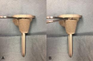 肋骨固定板怎么拆手术技巧：全膝关节翻修如何取出固定良好的胫骨柄锥_https://www.jmylbn.com_新闻资讯_第4张
