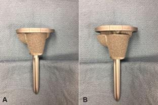 肋骨固定板怎么拆手术技巧：全膝关节翻修如何取出固定良好的胫骨柄锥_https://www.jmylbn.com_新闻资讯_第7张