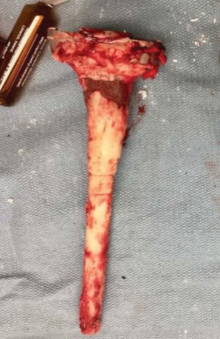 肋骨固定板怎么拆手术技巧：全膝关节翻修如何取出固定良好的胫骨柄锥_https://www.jmylbn.com_新闻资讯_第1张