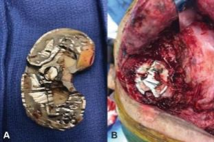 肋骨固定板怎么拆手术技巧：全膝关节翻修如何取出固定良好的胫骨柄锥_https://www.jmylbn.com_新闻资讯_第5张