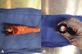 肋骨固定板怎么拆手术技巧：全膝关节翻修如何取出固定良好的胫骨柄锥_https://www.jmylbn.com_新闻资讯_第6张