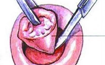 宫颈lct是什么预防宫颈癌，除了HPV疫苗、HPV、LCT筛查，宫颈锥切少不了_https://www.jmylbn.com_新闻资讯_第9张