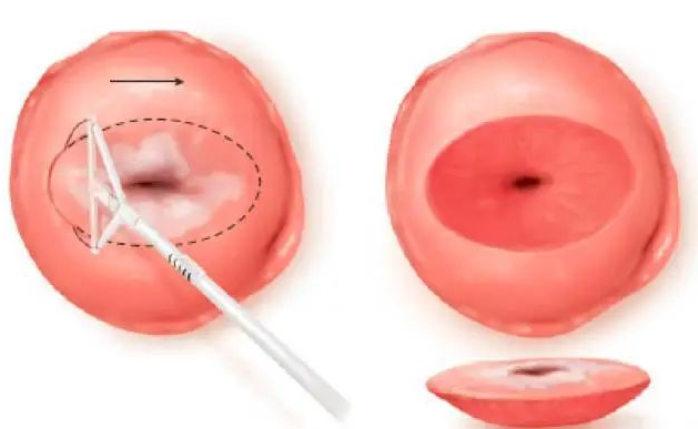 宫颈lct是什么预防宫颈癌，除了HPV疫苗、HPV、LCT筛查，宫颈锥切少不了_https://www.jmylbn.com_新闻资讯_第8张